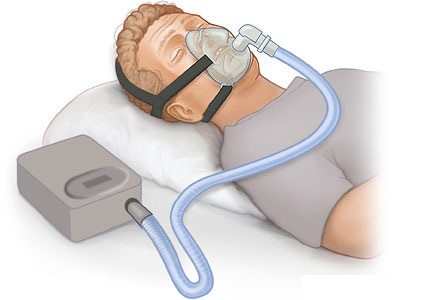 Sleep Apnea